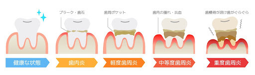 歯周病を放っておくとどうなる？